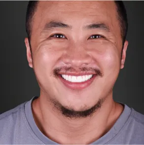 Overview of 3-on-6 dental implants procedure in Mexico, showcasing high-quality implant placement for a complete smile restoration.