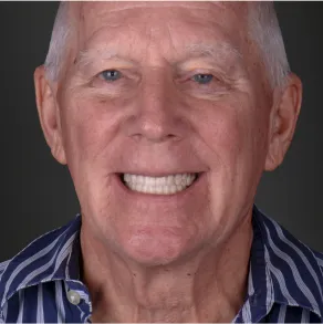 All-on-X dental implant solution in Mexico, providing versatile and comprehensive smile restoration options.