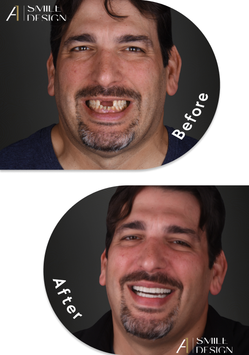Visual comparison of pre- and post-All-on-4 treatment in Mexico, highlighting dental restoration quality.