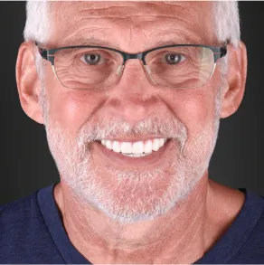 Snap-on dentures available at Mexican dental clinics, offering flexible and convenient tooth restoration options.